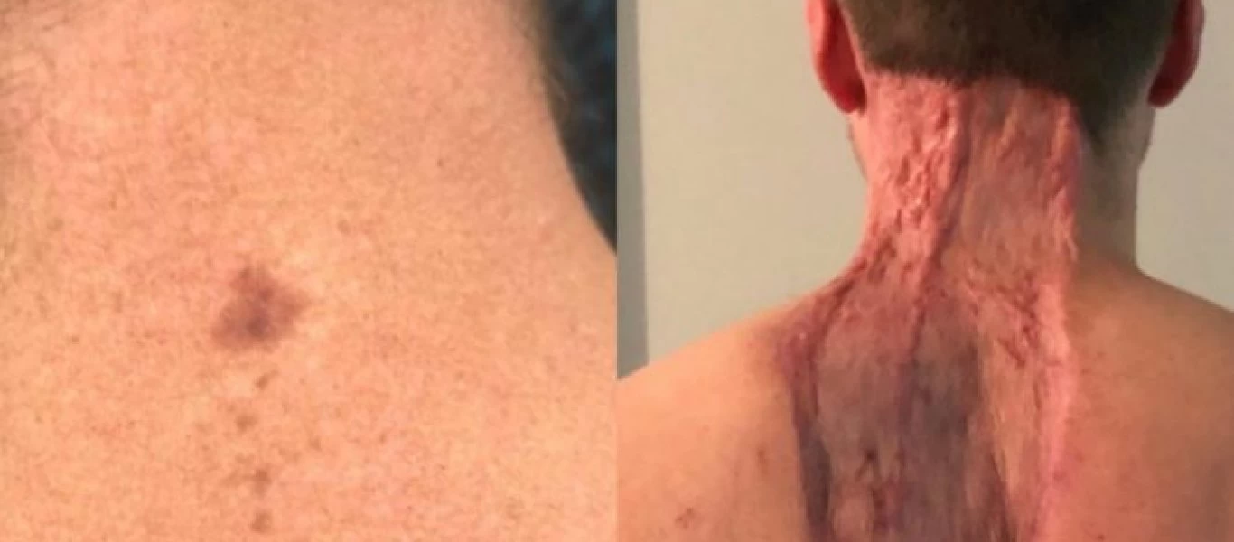 Η «αθώα» ελιά που είχε ήταν μελάνωμα: Του αφαίρεσαν 40 εκατοστά δέρμα (φώτο)